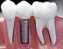 implants1-image